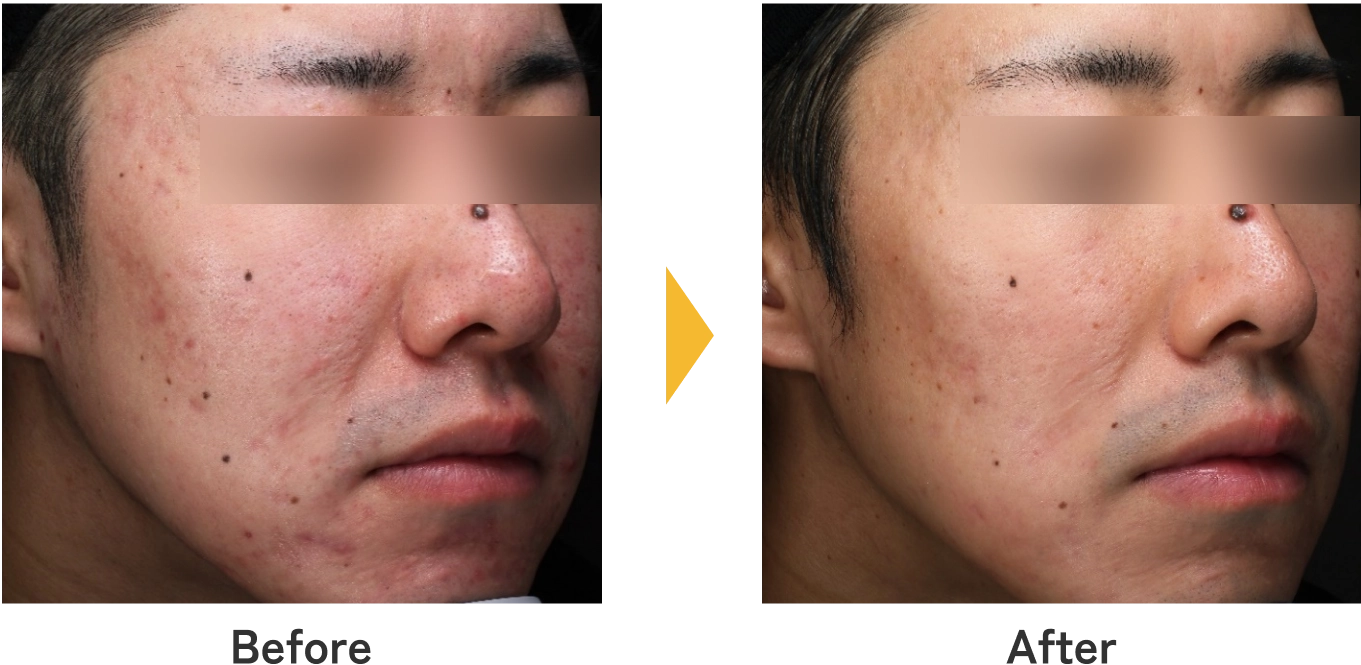 中等症ニキビ治療のBefore/After