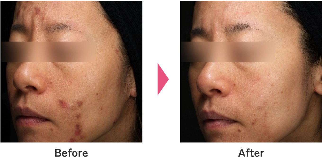 重症ニキビ治療のBefore/After