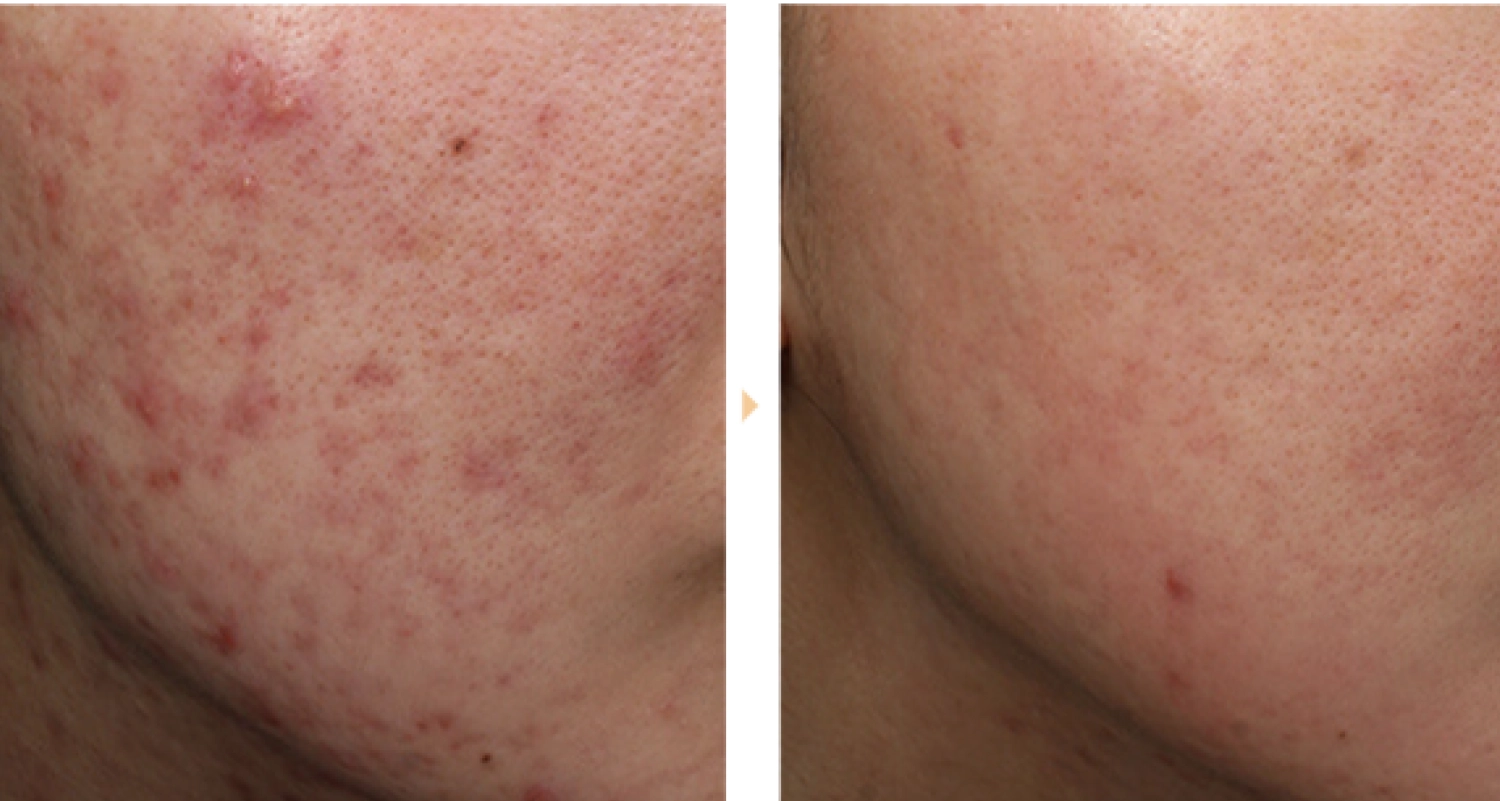 ケミカルピーリング